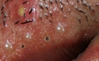 5 Proven Tips to Remove Blackheads and Achieve Clear Skin!