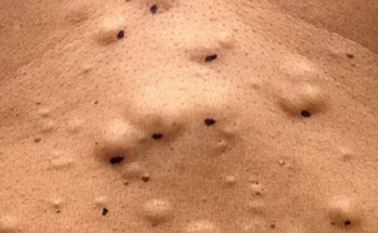 A Belly Full of Steatocystomas Full Video: The Must-See Extraction Sensation!