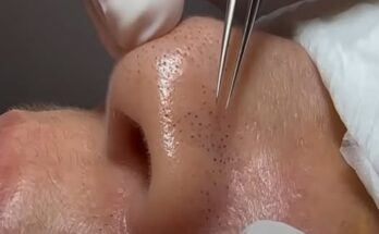 Blackheads Cleaning Treatment: The Ultimate Guide to Clear Skin
