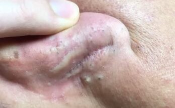 The Mighty Army of Ear Pimples 🪖 A Rare Sight Behind the Ear