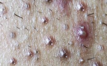 Effective Blackhead Removal: Top Treatments and Skincare Tips