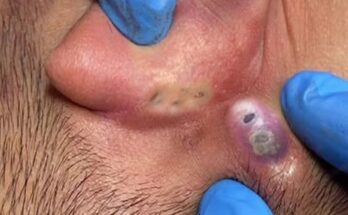 How to Safely Remove an Abscess Behind the Ear: Treatment and Prevention