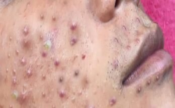 How to Treat Blackheads: Effective Tips and Remedies