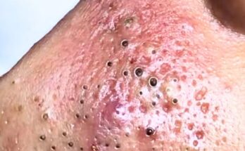 "The Ultimate Guide to Powerful, Root-Removing Blackhead Treatments for Clear Skin"