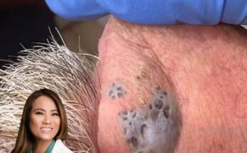 Popping Nose Blackheads What You Need to Know