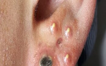 Say Goodbye to Ear Blackheads: Effective Removal Techniques That Work