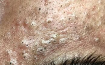 Under Eye Deep Blackheads Understanding and Treating a Persistent Concern