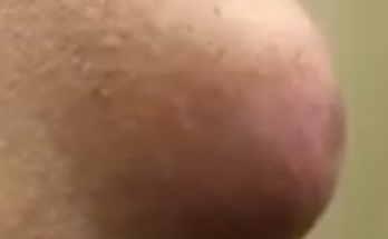 Meatball Cyst Removal on Shoulder: Flashback to a Fascinating Procedure