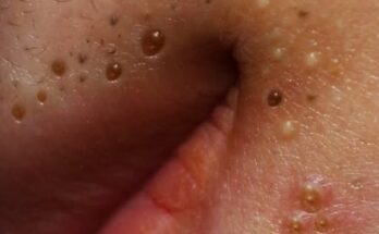 Blackheads vs. Whiteheads: Understanding the Differences and How to Treat Them