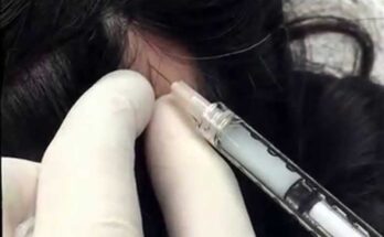 Understanding and Treating Alopecia Areata: Insights from Dr. Pimple Popper