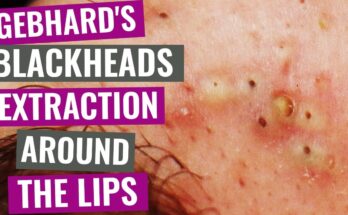 Gebhard's Blackheads extraction around the lips