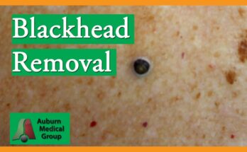 Blackhead Removal Without Extractor Tool