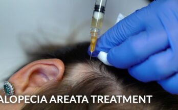 Innovative Treatments for Alopecia Areata: PRP, Stem Cells, and Steroid Injections