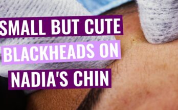 Small, but yet Cute Blackheads Around Nadia's Chin
