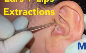 Ultimate Guide to Acne Extractions: Removing Large Blackheads and Whiteheads in Ears and on Lips