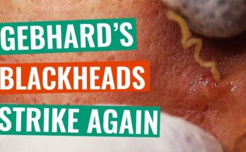 Gebhard’s Blackheads Strike Again, and This Time Full-Face Treatment - Part 1