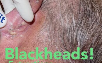 Ultimate Ear Blackhead Extractions: Expert Techniques for Deep Plugs, Dry Blackheads, and Cyst Pops