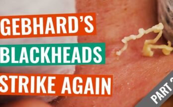 Gebhard’s Blackheads Strike Again (Lip Blackhead Bonus) - Part 2