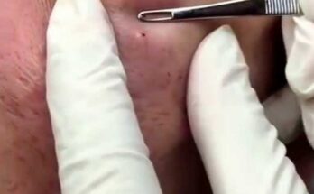 Blackhead and Milia Extraction: A Medical Education Video