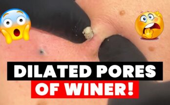 Understanding Dilated Pores of Winer: Causes, Treatments, and Prevention for Clearer Skin
