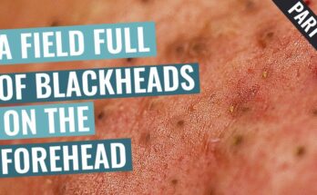 A Field Full of Blackheads on Aimilios’s Forehead - Part 1 out of 4