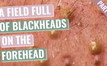 A Field Full of Blackheads on Aimilios’s Forehead and eyebrows - Part 2 out of 4