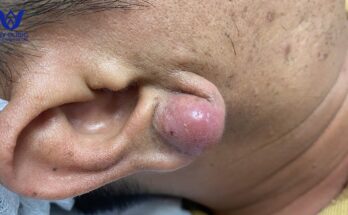 How to Identify, Prevent, and Treat Cysts for Clear, Healthy Skin