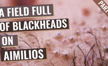 Field Full of Blackheads on Aimilios’s Nose and Around The Lips - Part 3 out of 4