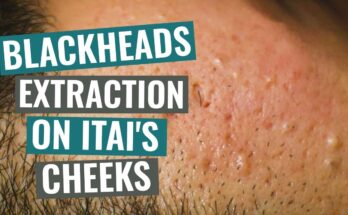 Blackheads extraction on Itai's cheeks