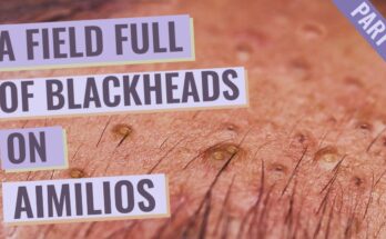 A Field Full of Blackheads Around Amilios’s Eyebrow - Part 4 out of 4