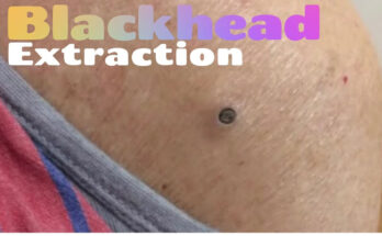 Clear Your Shoulders of Blackheads with Expert Extraction by Dr. Steven Greene in Seattle